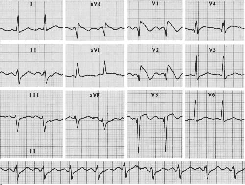 ECG picture - is this a RBBB? Wide bizarre R prime waves in V1 and adjacent leads