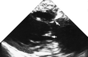 echo: 2-chamber view (longitudinal)
