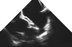 echo: left atrial appendage (basal)